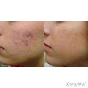 herbal scar removal cream call/whats app +256777422022