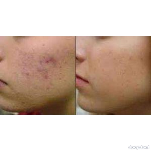 herbal scar removal cream call/whats app +256777422022
