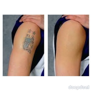 tattoo removal spray call/whats app +256777422022