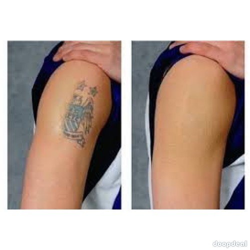 tattoo removal spray call/whats app +256777422022