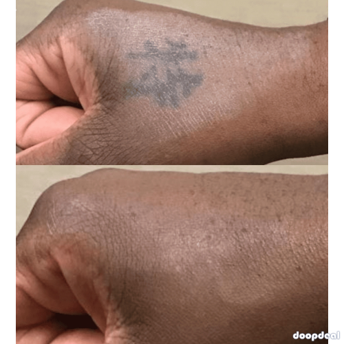 tattoo removal spray call/whats app +256777422022